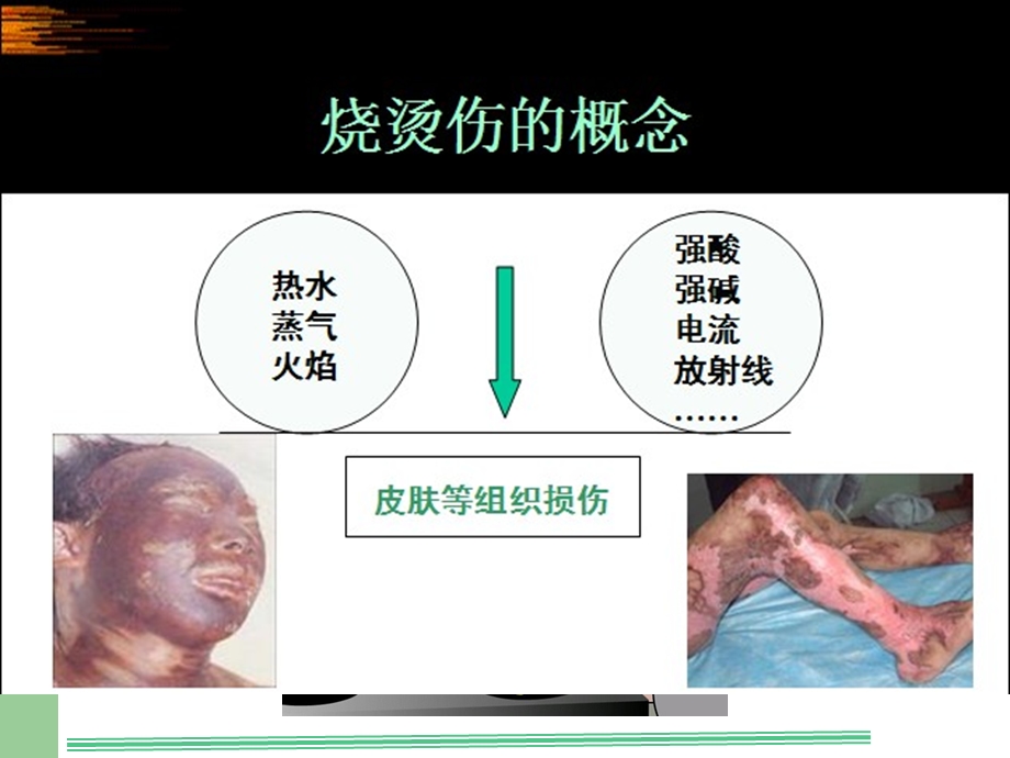 烧烫伤的院前急救课件.ppt_第3页