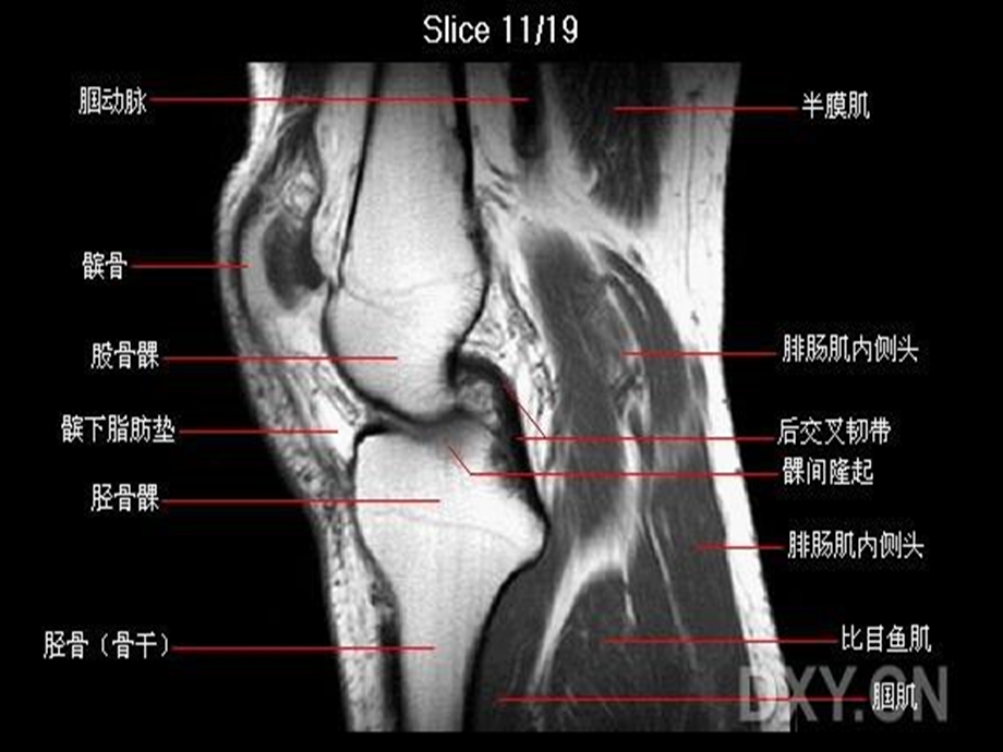 膝关节核磁共振.ppt_第2页