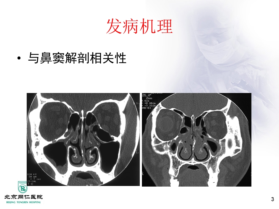 鼻窦炎及并发症.ppt_第3页