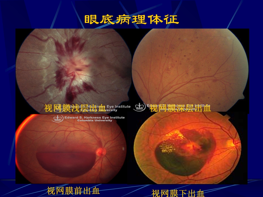 视网膜血管疾病.ppt_第2页