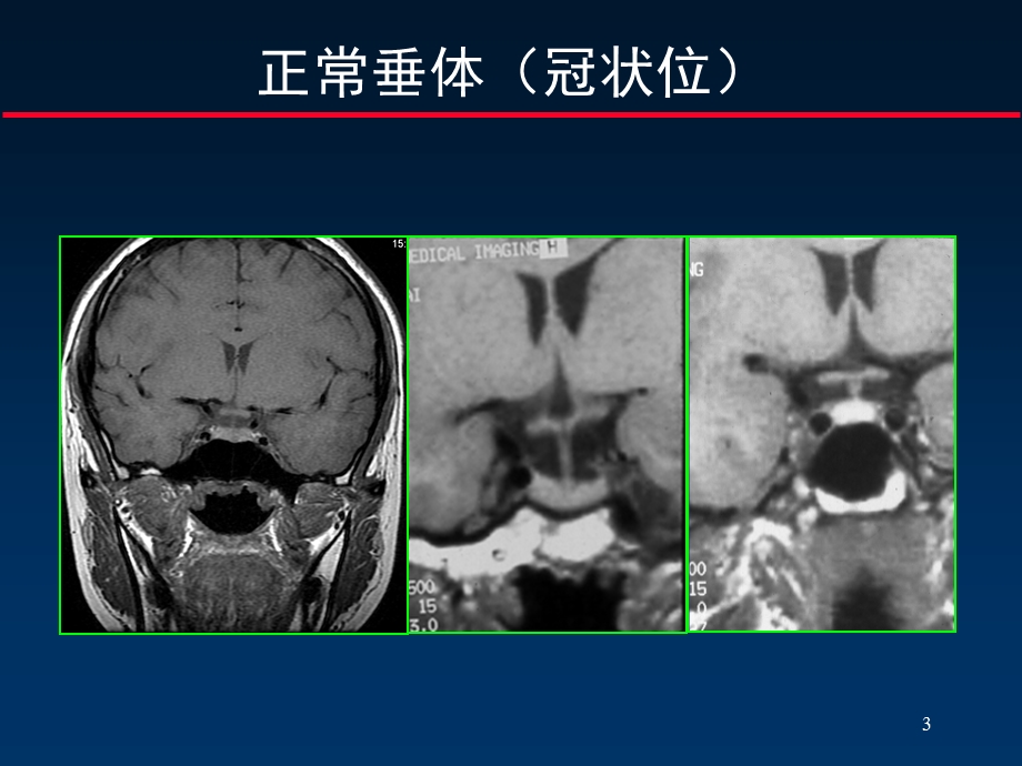 鞍区病变断解10.ppt_第3页