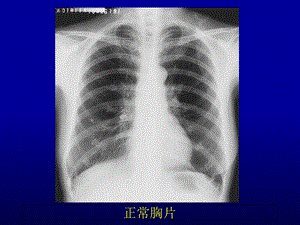 肺部正常和X线异常表现.ppt