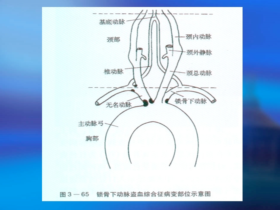 锁骨下动脉盗血综合征PPT课件.ppt_第3页