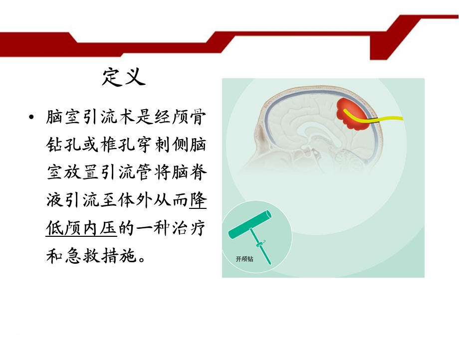 脑室外引流管的护.ppt_第3页