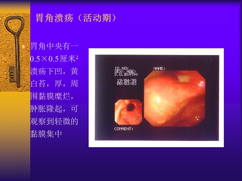 消化性溃疡详解(含图).ppt_第2页