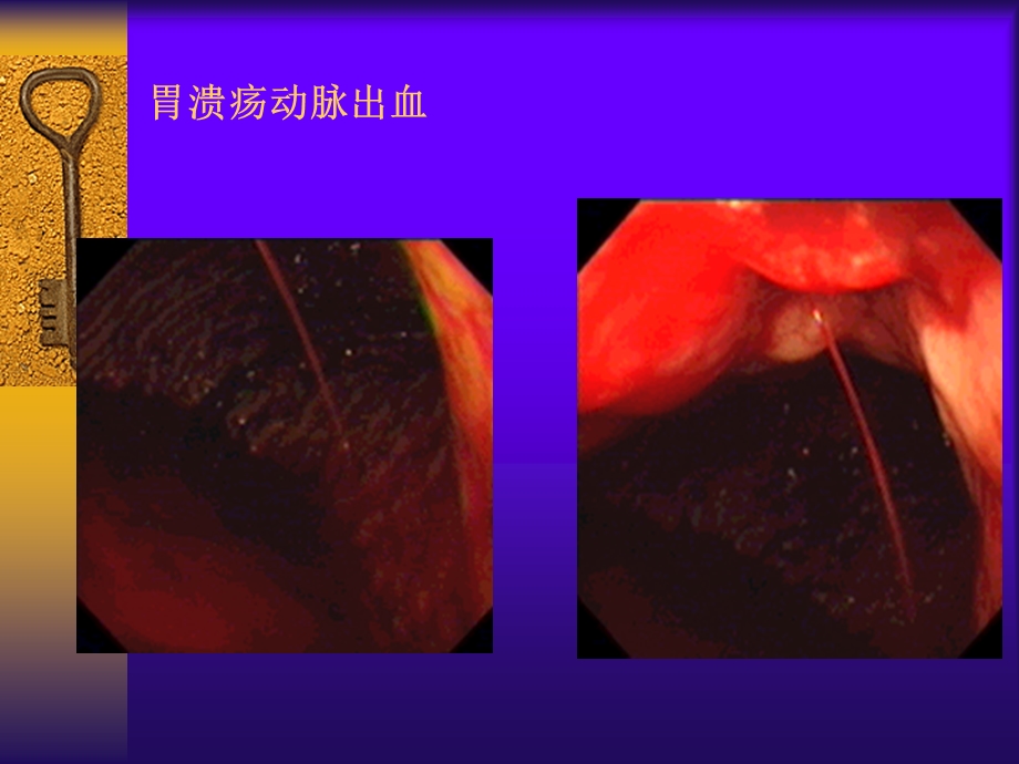 消化性溃疡详解(含图).ppt_第3页