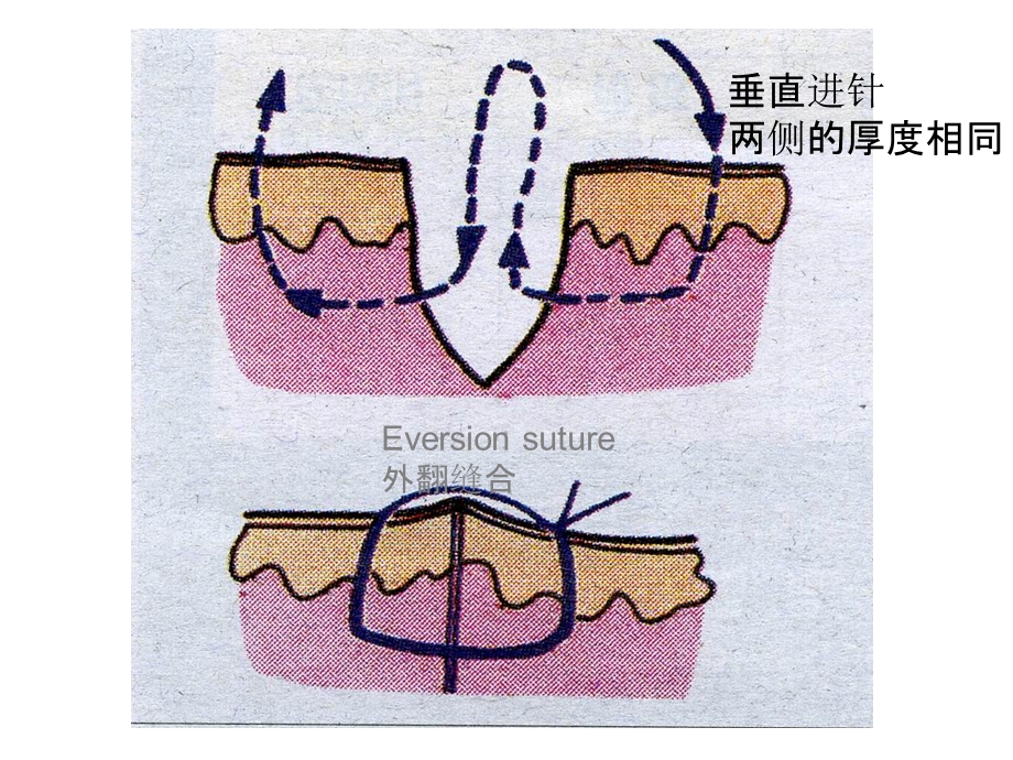 种植牙常用缝合技术图解.ppt_第3页