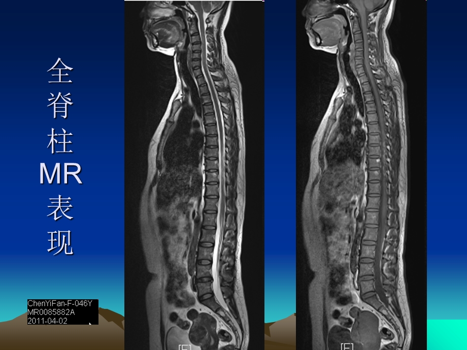 脊柱外伤影像学表现.ppt_第3页