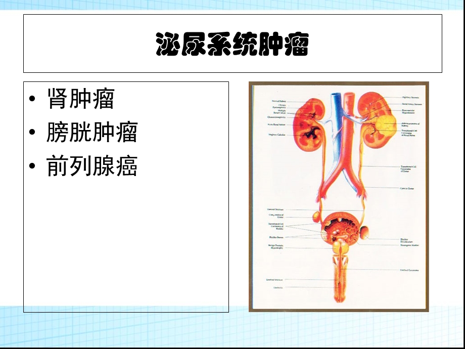 泌尿系统肿瘤(图文).ppt_第2页