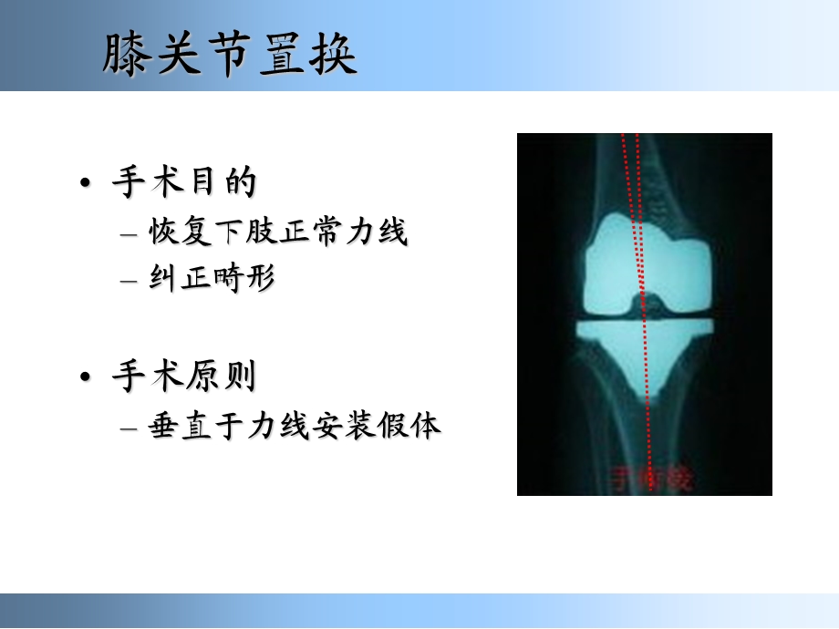 膝关节置换标准技术.ppt_第3页