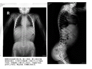 软骨发育不全.ppt