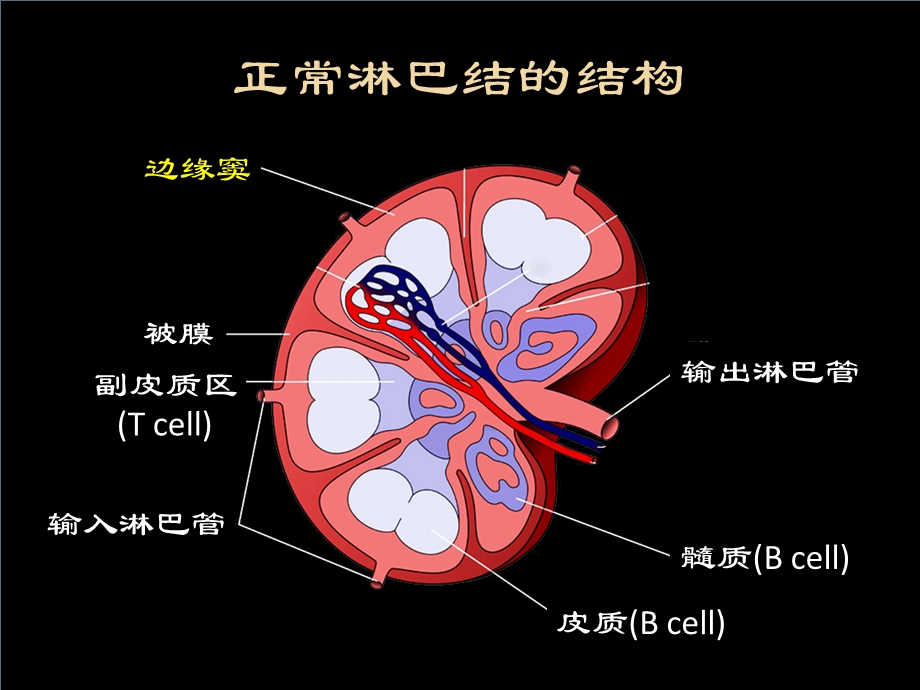 淋巴造血系统(淋巴瘤).ppt_第3页