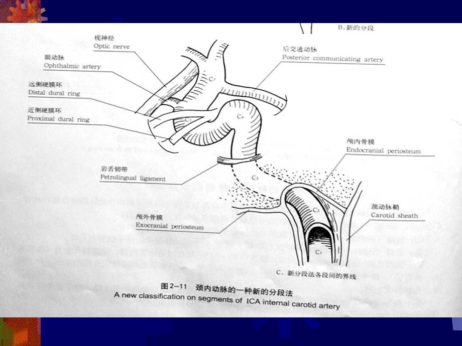 脑血管变异与临床.ppt_第3页