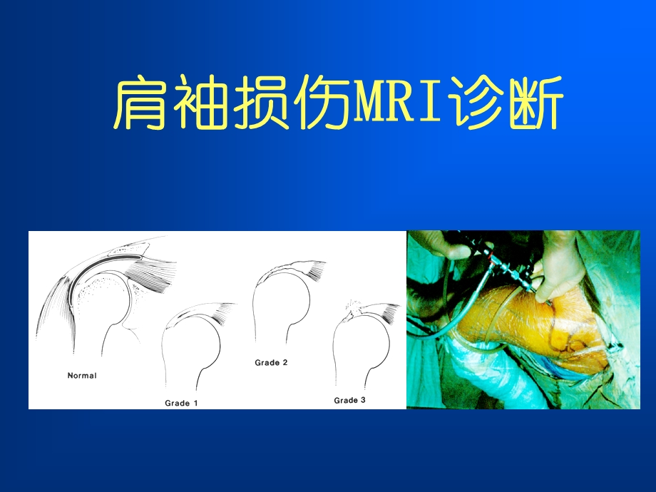 肩袖损伤MRI诊断.ppt_第1页