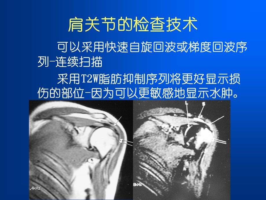 肩袖损伤MRI诊断.ppt_第3页