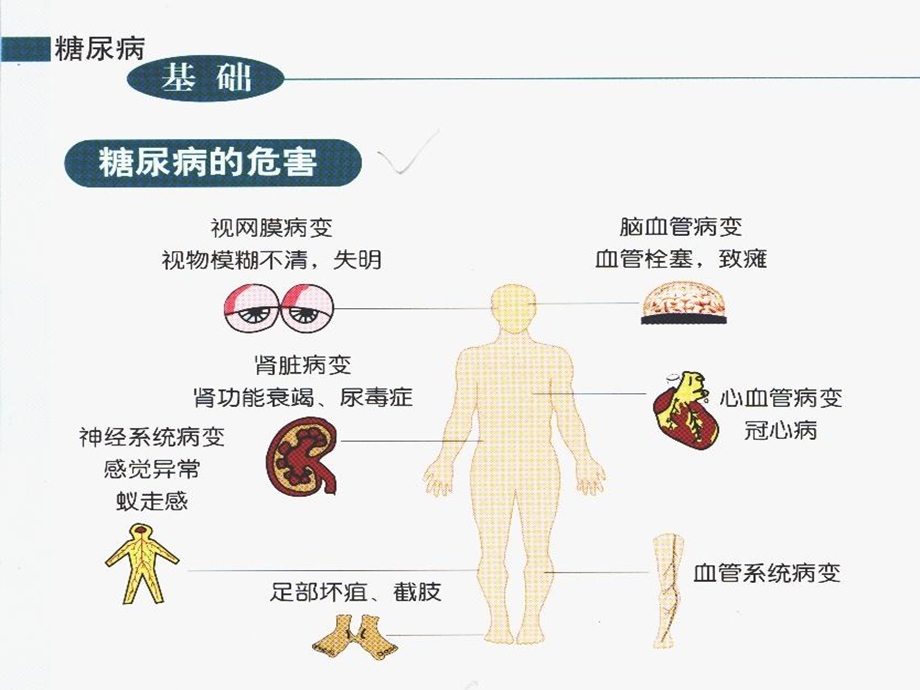 糖尿病的病因及发.ppt_第2页