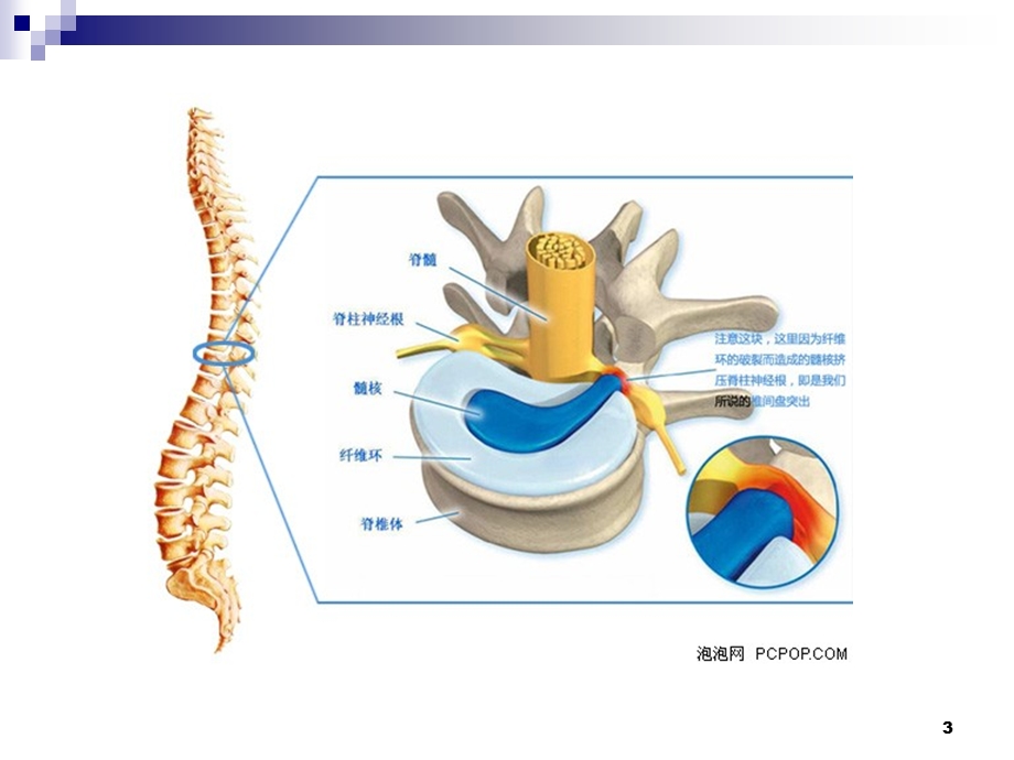 腰椎间盘突出的影像诊断.ppt_第3页