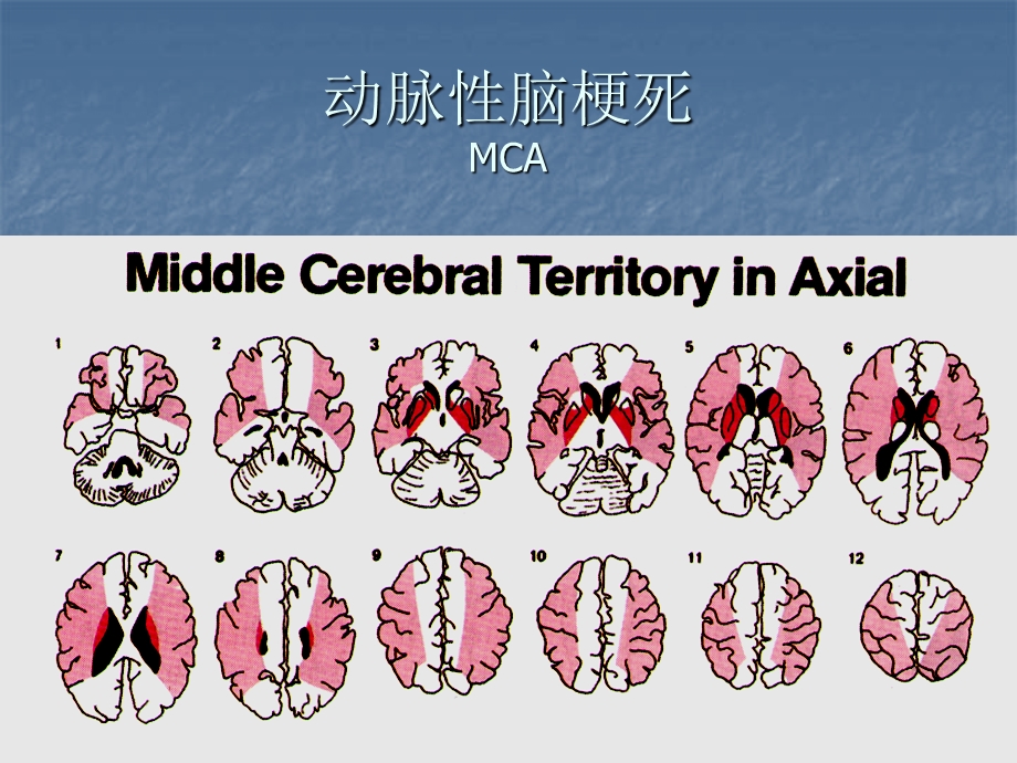 脑梗死责任血管判断.ppt_第3页