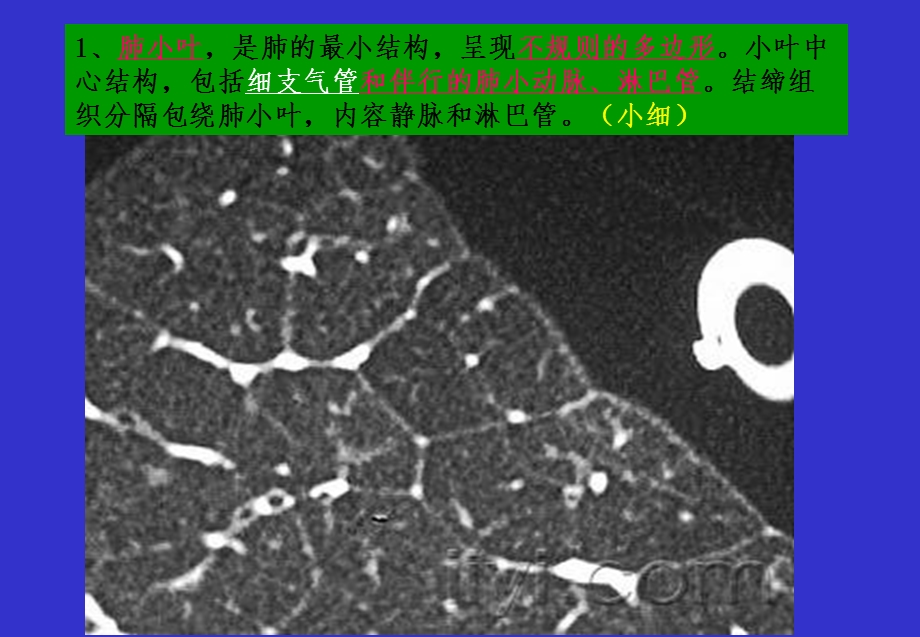 胸部基础病变CT征象.ppt_第3页