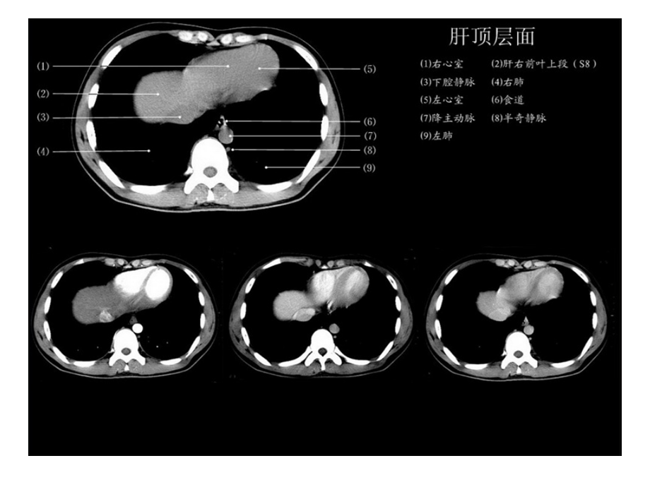 正常肝脏CT解剖图.ppt_第2页