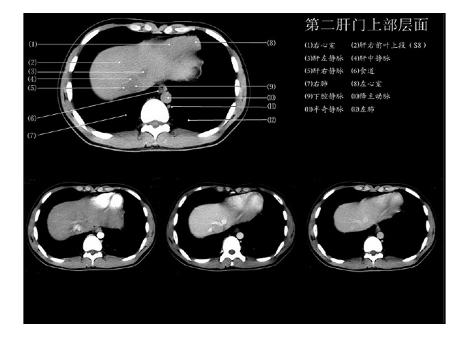 正常肝脏CT解剖图.ppt_第3页