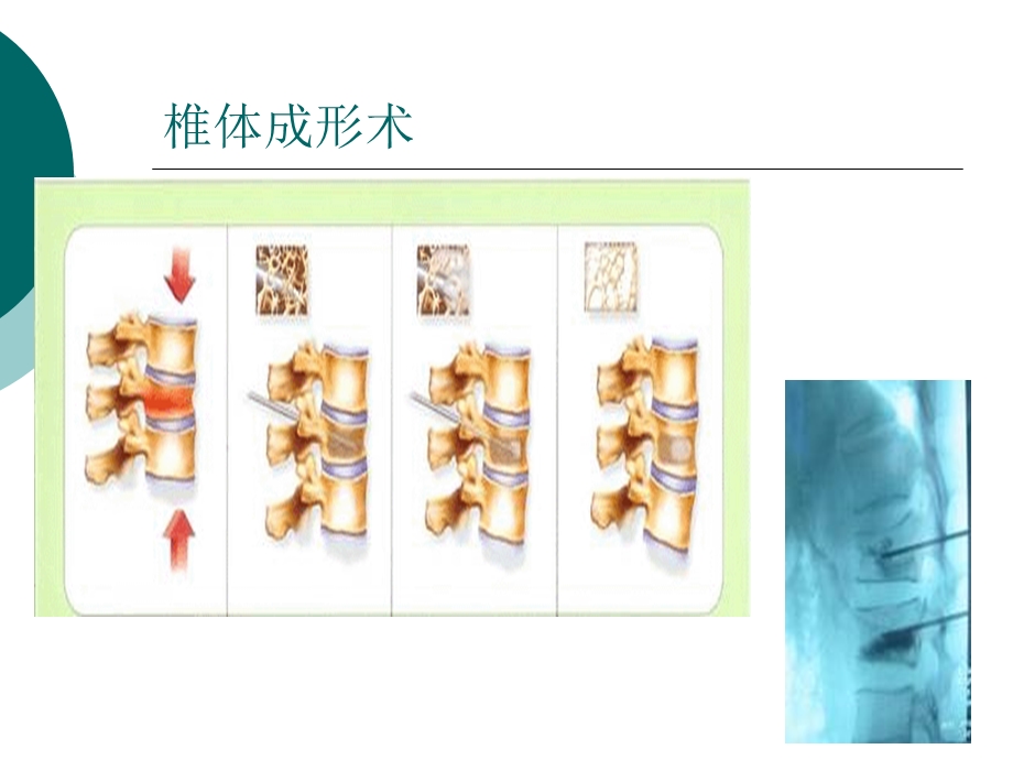 经皮椎体后凸成形术.ppt_第2页