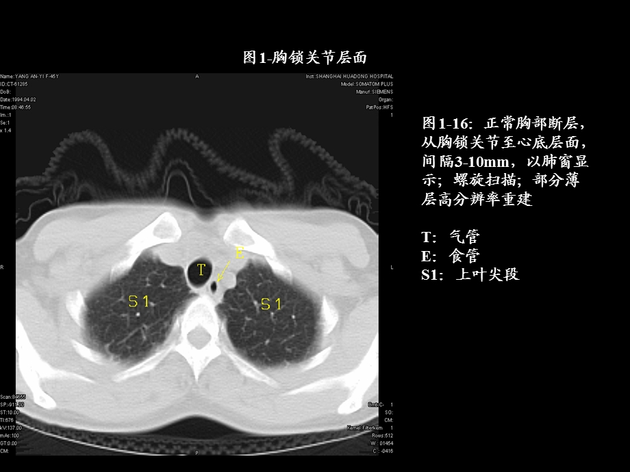 胸部肺段划分CT.ppt_第1页