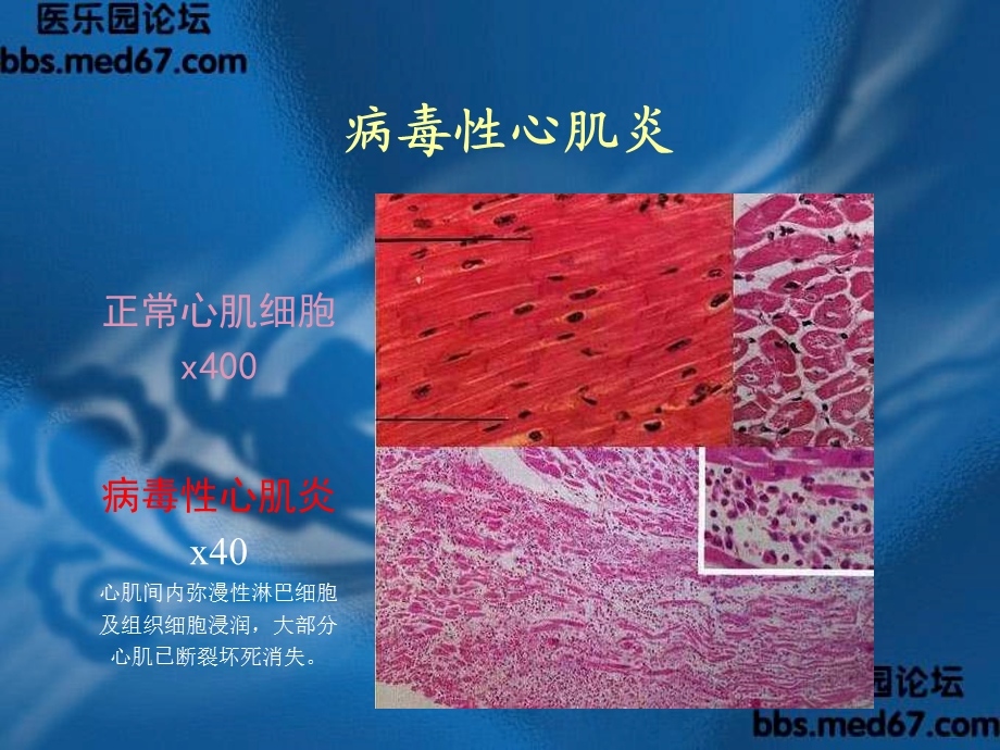 小儿病毒性心肌炎讲座.ppt_第3页