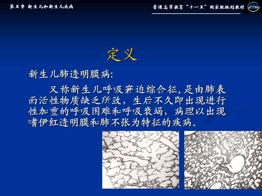 生儿肺透明膜病.ppt_第3页