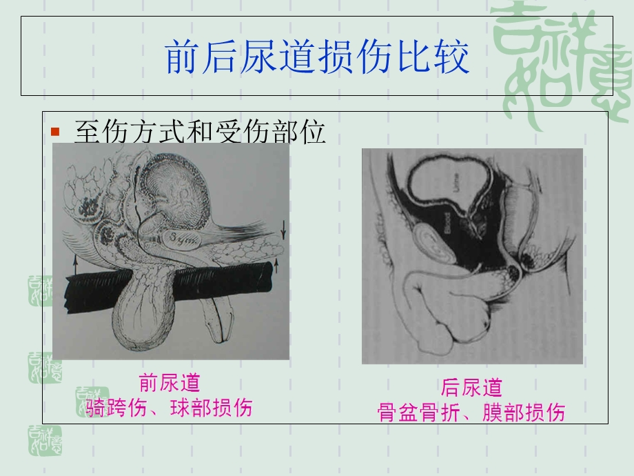 尿道损伤的治疗与护理.ppt_第3页