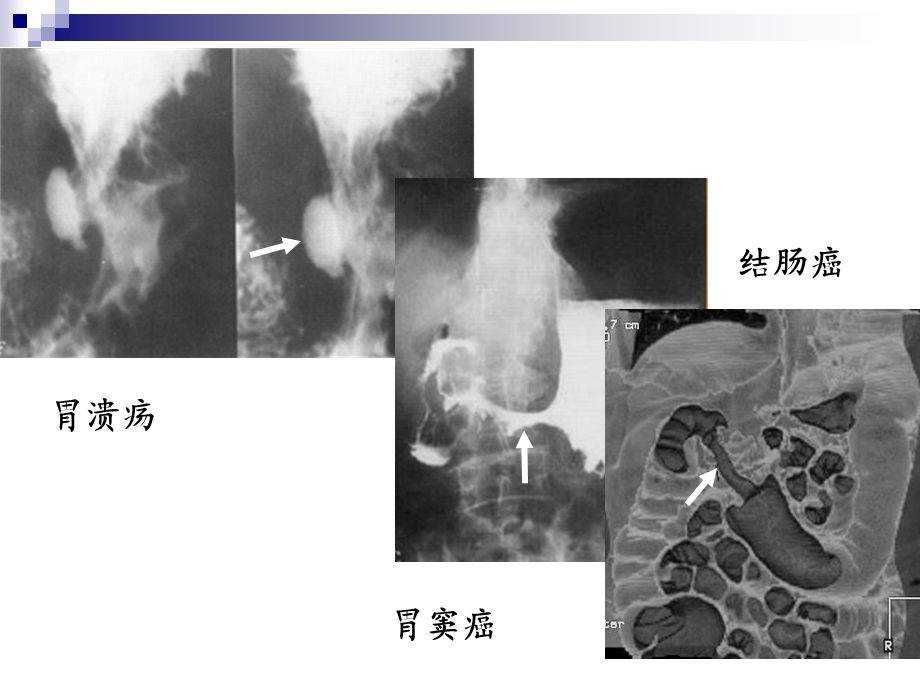 胃肠道疾病影像诊断总论.ppt_第3页