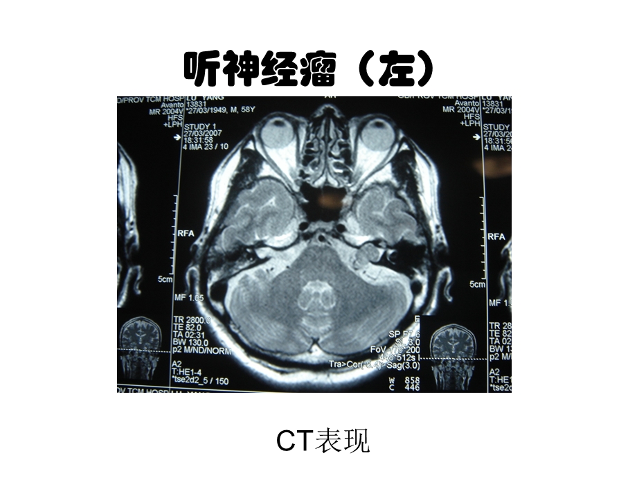 听神经瘤左.ppt_第1页