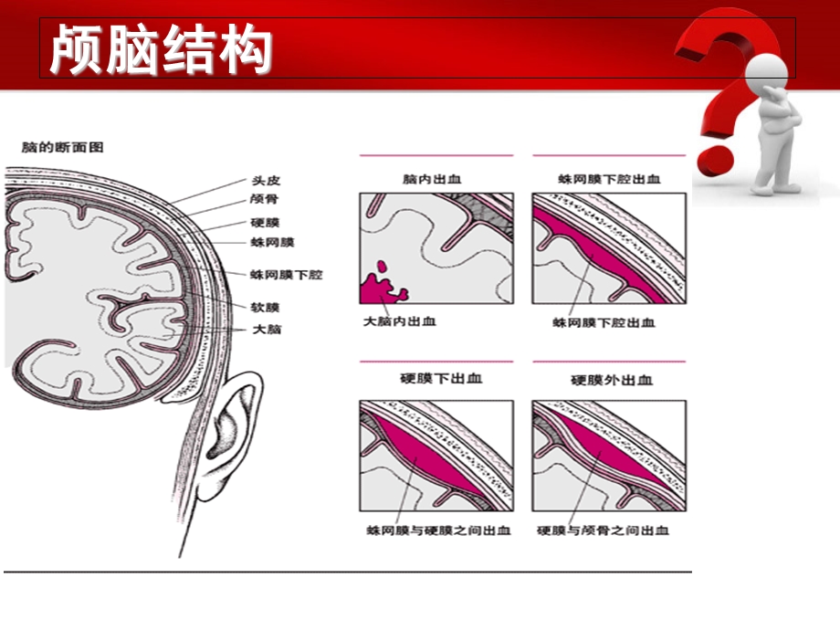 蛛网膜下腔出血的护理要点.ppt_第3页