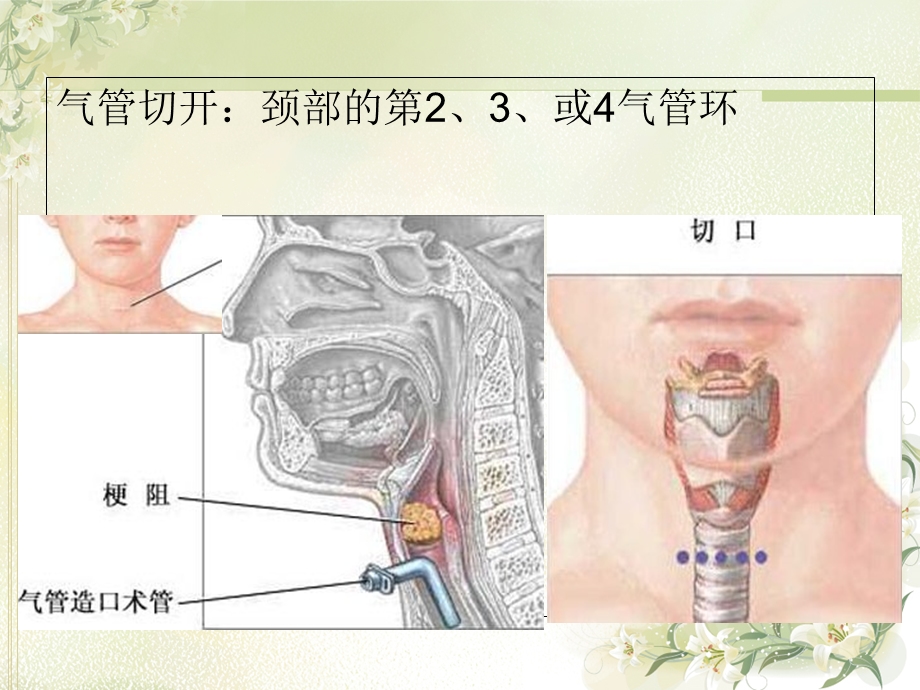 气管切开的术后护理.ppt_第3页