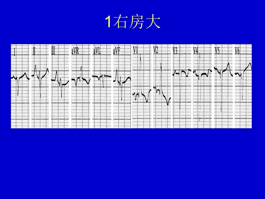 心电图典型图谱.ppt_第1页