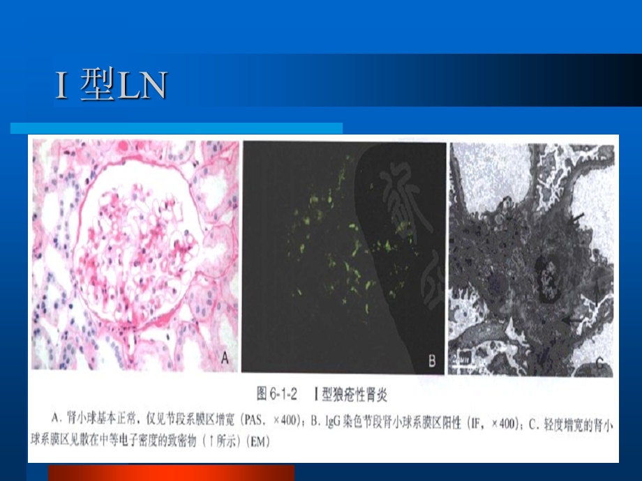 狼疮性肾炎病理分型及治疗.ppt_第3页