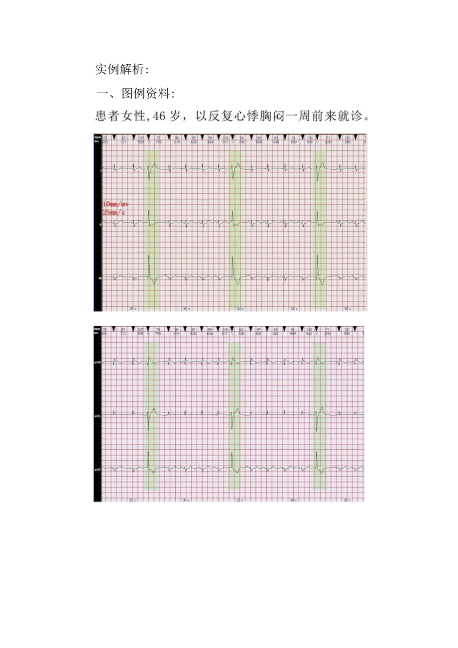 心电图室医师晋升副主任（主任）医师高级职称病例分析专题报告（心电图病例分析：左前分支型室性早搏）.docx_第3页