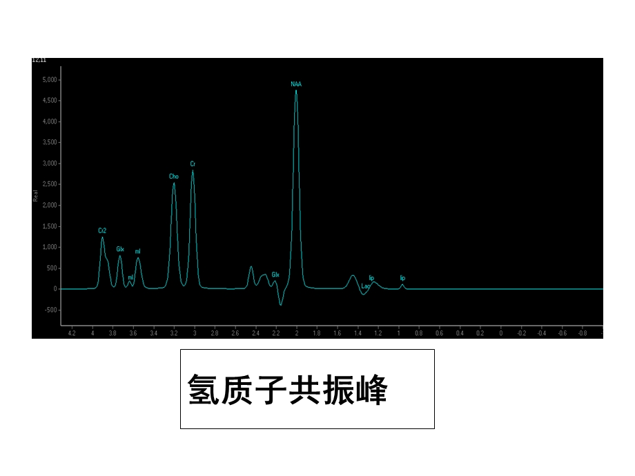 脑外DWI、MRS临床及原理.ppt_第3页