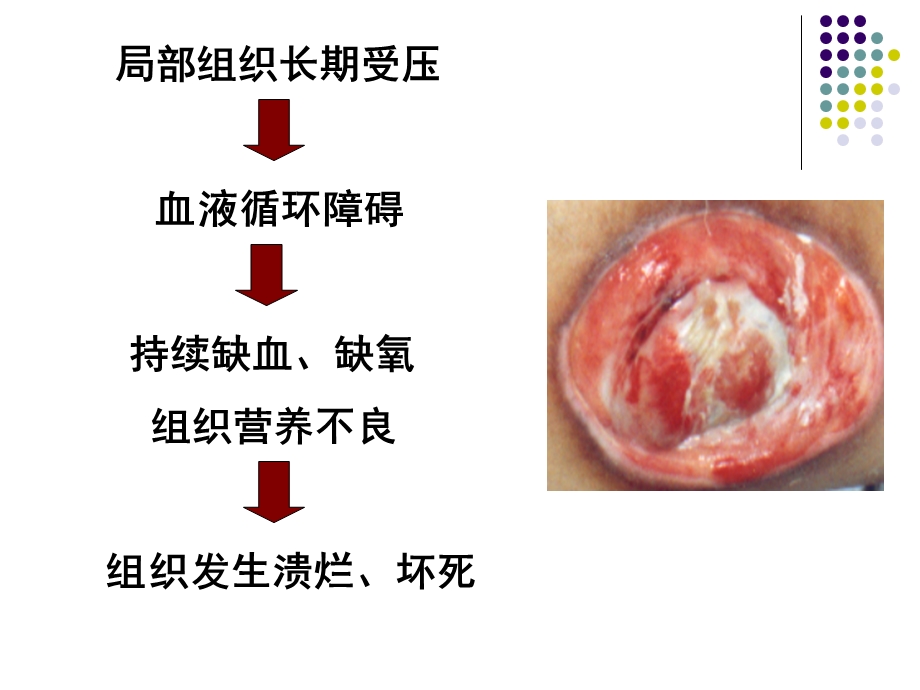 压疮预防及护理PPT.ppt_第3页