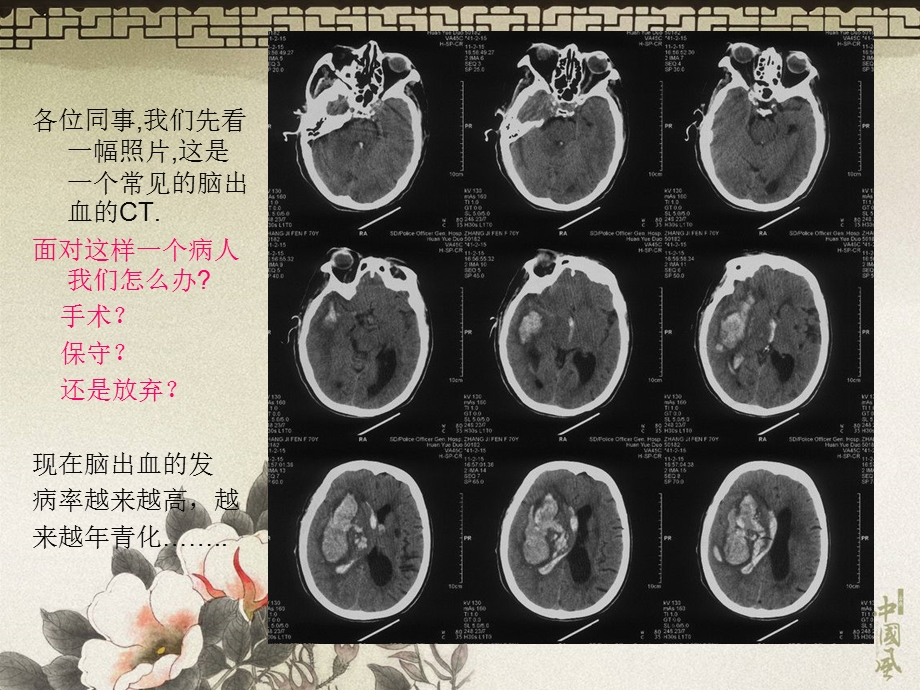 高血压脑出血的治疗－蒋小杰.ppt_第2页