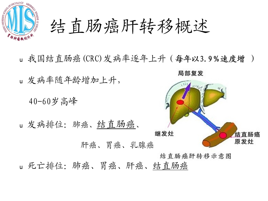 结直肠癌肝转移消融.ppt_第3页