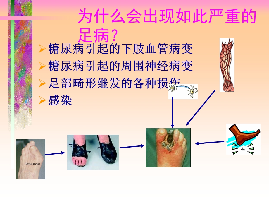 糖尿病足内分泌.ppt_第3页