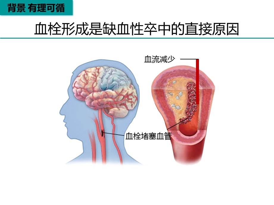 脑梗死再灌注治疗.ppt_第3页