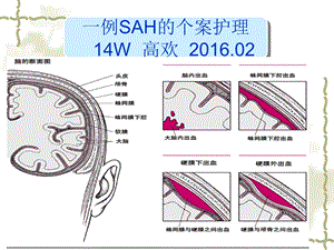 蛛网膜下腔出血的个案护理.ppt