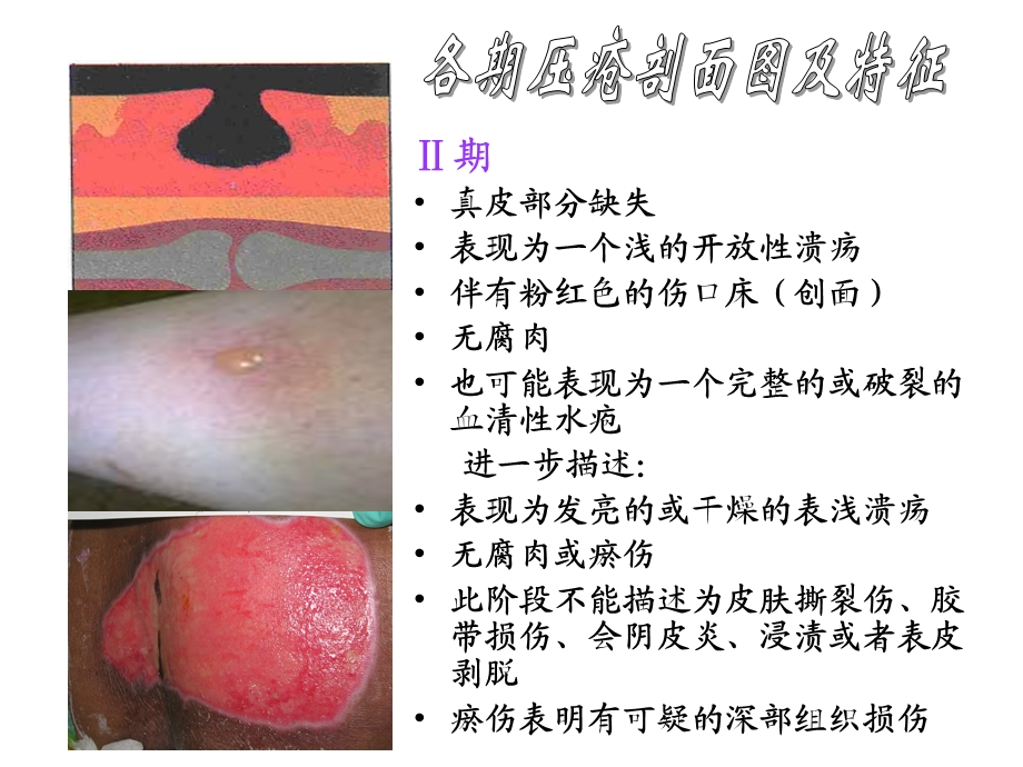 压疮分期图片及文字说明.ppt_第2页