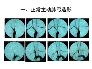 正常脑血管造影.ppt