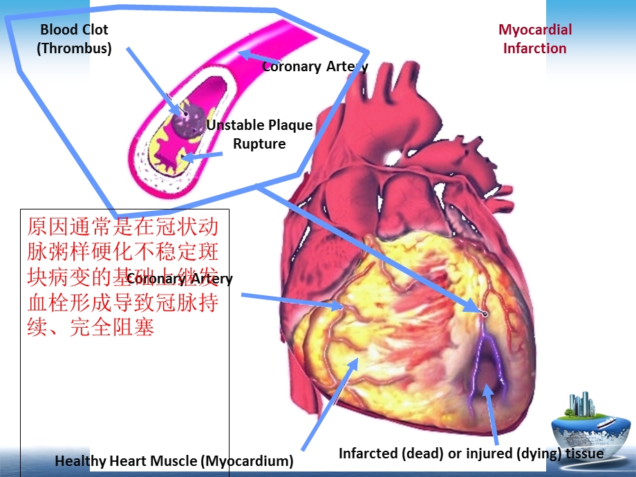 心肌梗死病理、病理生理和临床表现.ppt_第3页