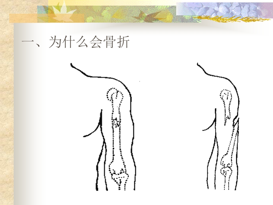 骨折许群英 ppt课件.ppt_第3页