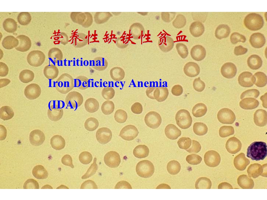 营养性缺铁性贫血.ppt_第1页