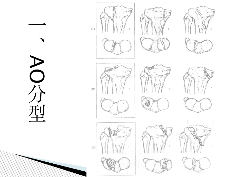 胫骨平台后侧柱骨折.ppt_第3页